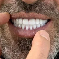 ساخت دندان مصنوعی طرح لمینیت