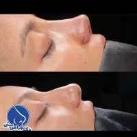 جراحی زیبایی بینی فقط با ۳۲ میلیون تومن