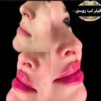 تخفیف ژل و بوتاکس و مزوژل