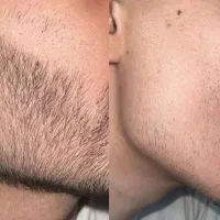 آیا از نداشتن ریش و سیبیل رنج میبری