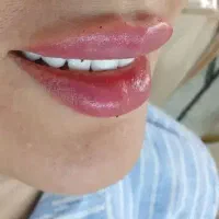 ژل لب و فیلر لب