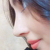 جشنواره جراحی رینوپلاستی عمل بینی دکترصادقزاده