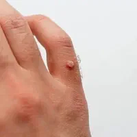 درمان زخم باز وزگیل میخچه باپلاسما هلیوم کرایومنزل