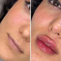 آموزش ژل و بوتاکس توسط دکتر در مطب با مدرک