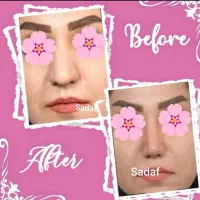 انجام خدمات فیلر ژل بوتاکس
