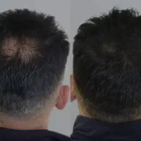 ریزش مو و ریزش موی سکه ایی