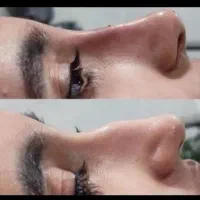 تزریق ژل بوتاکس +لیفت بینی با مواد تضمینی
