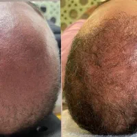 برای اولین بار در ایران بدون کاشت