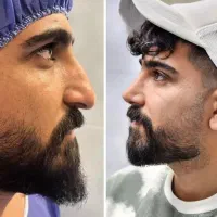 جراحی عمل بینی لیپو ابدو لیفت سینه پروتز مامو