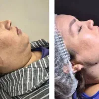 تخلیه چربی شکم پهلو ۳۶۰ درجه فقط۳۸ میلیون