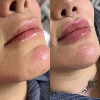 اموزش تزریق فیلر و بوتاکس ، مزو و پی ارپی