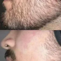 محصول جدید سرم ریشات
