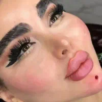 خانم دکتر ذهابی تزریق ژل مزوژل بادی اگزوزوم بوتاکس