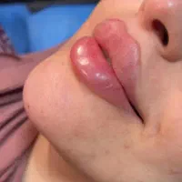 ۱ مدل فیلرلب وبوتاکس
