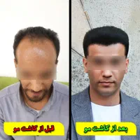کاشت تخصصی مو و ریش و ابرو (توسط تیم شیرازی)