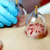حجامت و بادکش سیار