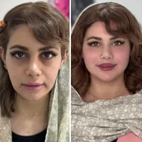 فیلر بوتاکس مزو تراپی مزو ژل خالبرداری