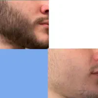 رویش ریش و سیبیل