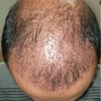 کاشت مو تخصصی/کاشت بیشترین تعداد تارمو/تضمینی