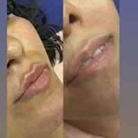 تزریق ژل بوتاکس هایکو فیلم بادی