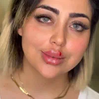 ژل فیلرصورت وفیلربادی و مزوژل  باقیمت استثنایی