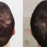 PRP ممنوع|آرایشی، بهداشتی، درمانی|شیراز, وصال|دیوار