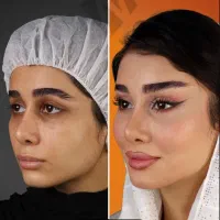 جراحی های زیبایی لیفت شقیقه ابرو صورت غبغب پلک