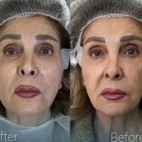تخفیف ویژه لیفت صورت با نخ لیفت و کلاژن