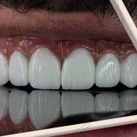 کامپوزیت به قیمت ۱۴۰۴