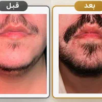 برای ریش کم پشت قبل خرید مشاوره بگیر.