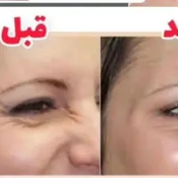 درمان چین و چروک|خدمات آرایشگری و زیبایی|جوادآباد, |دیوار