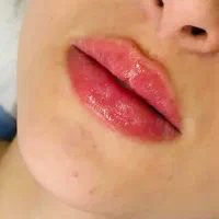 ژل ،بوتاکس،مزوژل، لیزر