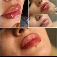 جشنواره ژل و بوتاکس