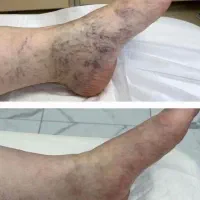 درمان ریشه واریس در خانه به صورت کاملا گیاهی