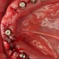 اقساط ویژه ایمپلنت و دندانپزشکی در تبریز