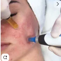 آف خدمات پی آر پی،مزوتراپی،مزونیدلینگ.بوتاکس