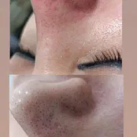 مدل پاکسازی پوست