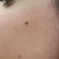جشنواره خال برداری با لیزر در مطب فقط۴۰۰