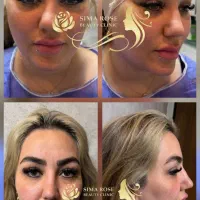 اندولیفت جراحی لیفت شقیقه گونه ابروچشم مینی بلفارو