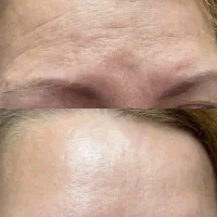 رفع چین و چروک و جوانسازی پوست