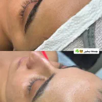 اسیدتراپی با خدمات رایگان ٪۵۰ تخفیف رفع جوش تضمینی