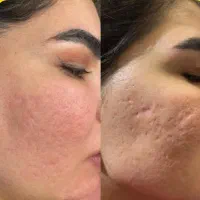 پی ار پی مزونیدلینگ سابسیژن لک جای جوش آکنه اسکار