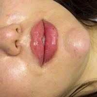 تزریق فیلر و بوتاکس
