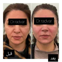 هایفو،آراف فرکشنال،کیوسوئیچ،کربوکسی،اوزون