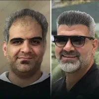 کاشت مو vip|خدمات آرایشگری و زیبایی|سنندج, |دیوار