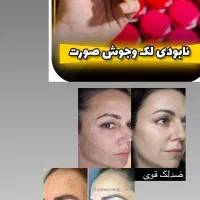 کرم معجزه ضد لک قوی