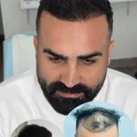 کاشت مو شیراز و کاشت میکروگرافت ابرو تهران در رشت
