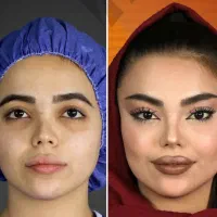 مدل زیبا وجوانسازی شفاف سازی لیف صورت به مدت محدود