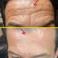چین و چروک و جوانسازی