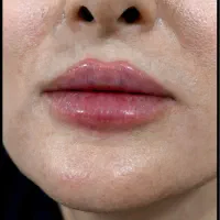تزریق فیلر توسط پزشک فقط هزینه مواد